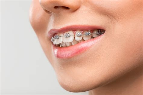 ¿De qué material están hechos los brackets más 